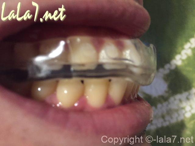 「歯ぎしりマウスガード」日本製　上の歯にかぶせ嚙合わせる